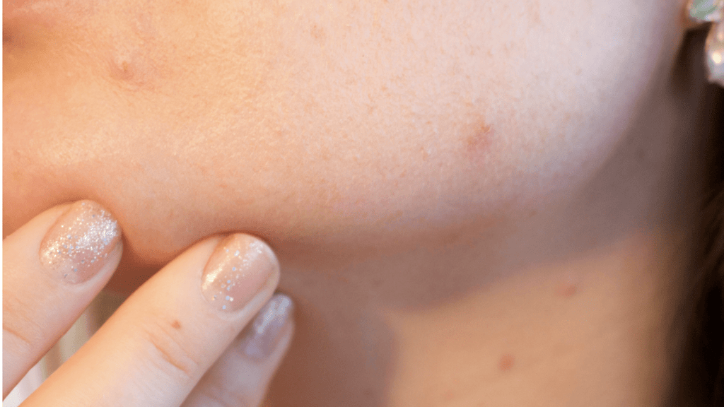 The Life Of A Pimple... - Lisa Sean Advanced Skin Care